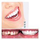 Facetas Dentárias Naturais Removíveis SmileFix Pro