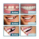 Facetas Dentárias Naturais Removíveis SmileFix Pro