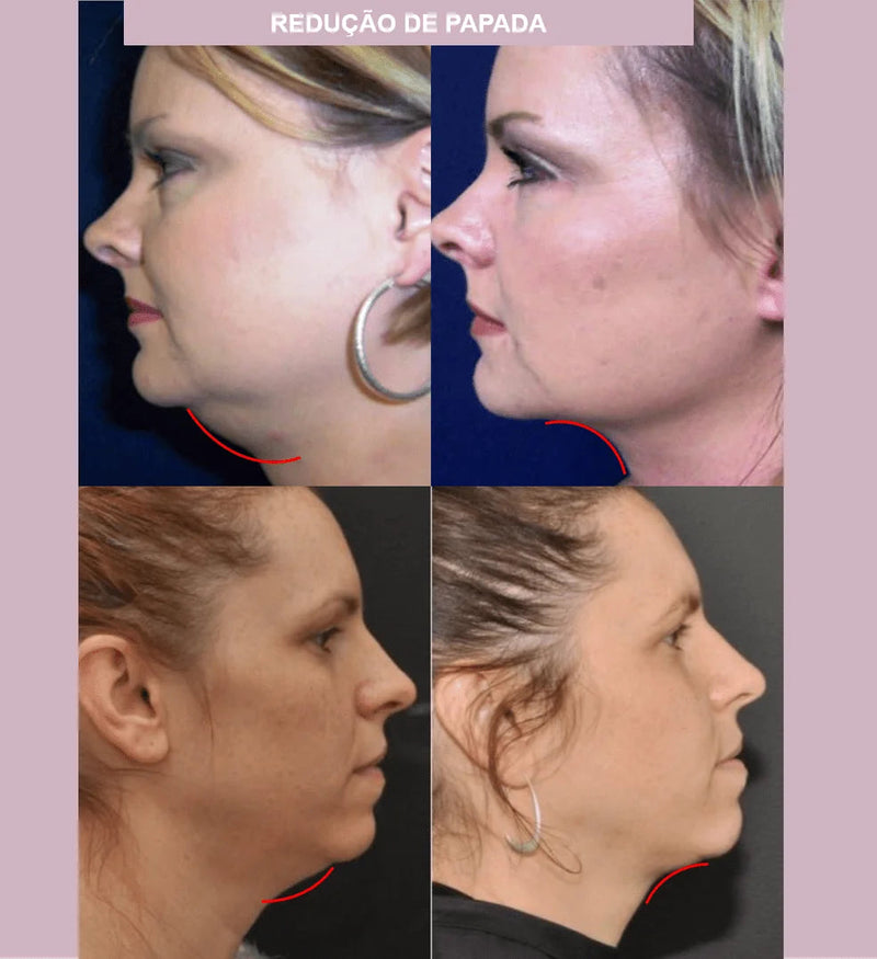 Máscara de Contorno Facial Suaviza Rugas e Papada Modela o Rosto